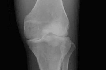 X-ray comparison illustrating joint cartilage differences